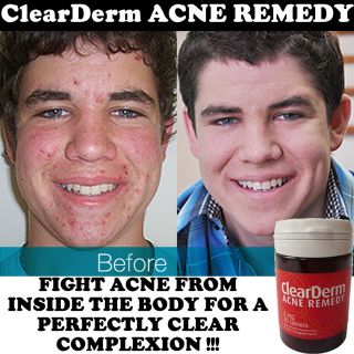 CLEAR DERM ACNE & SPOT PILLS. CLEARS ACNE, Black Heads, Pimples IN 30 