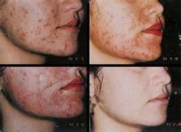 Acne Treatment Pure Unbuffered 70 Deep Strength Glycolic Acid Chemical 