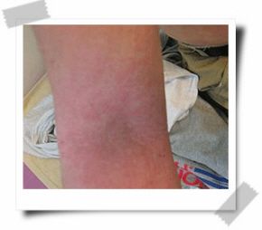 Purine x Herbal Remedy to Help Eczema Atopic Dermatit