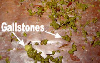 Gall Stone Removal Kit Remove Liver Stones Gallstones