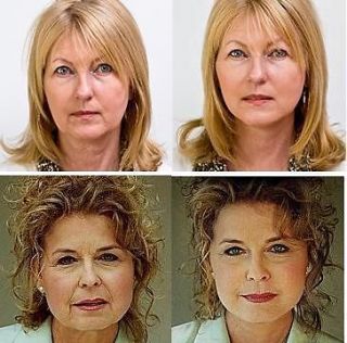 ANTI WRINKLE INSTANT FACELIFT & NECKLIFT TAPES KIT   NOW FROM UK